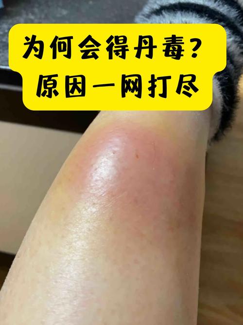 丹毒至效散百科详情 | 中医百科 - 笔尖中医